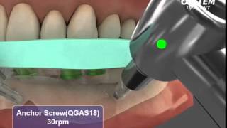 Hiossen  OSSTEM Guide  Guided Dental Implant Surgery [upl. by Andeee71]