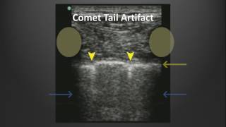 Ultrasound Artifacts [upl. by Koziarz607]