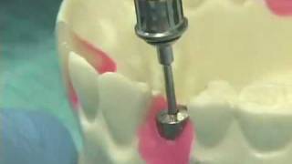 Placing Implant Abutments [upl. by Lebanna]