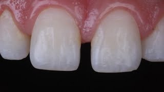 diastema closure with composite resin [upl. by Yllil]