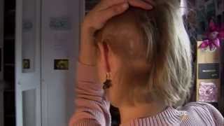 Trichotillomania Why These Women Rip Out Their Own Hair [upl. by Llehcor242]