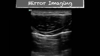 Ultrasound Physics Imaging Artifacts [upl. by Amlez544]