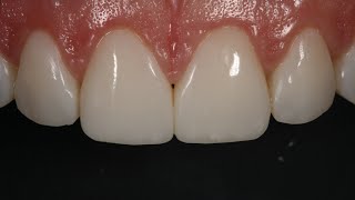 Resin Veneering and Freehand Diastema Closure [upl. by Wiener]