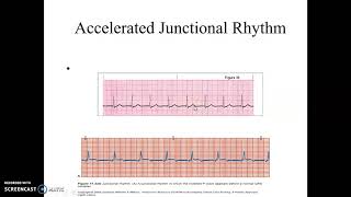 Accelerated Junctional and Junctional Tachycardia [upl. by Vassar]