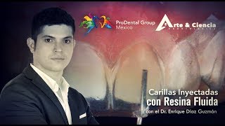 ►Carillas Inyectadas con Resina Fluida  Dr Enrique Díaz Guzmán [upl. by Pride567]