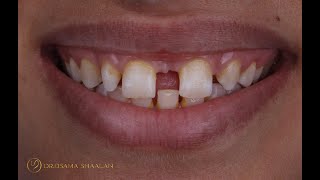 Combined approach for large diastema closure part II [upl. by Sanger]