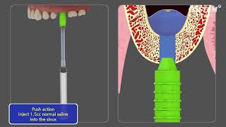 CAS KIT Crestal Approach  Sinus KIT [upl. by Katha]