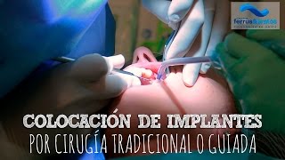 Colocación de implantes dentales [upl. by Tallou]