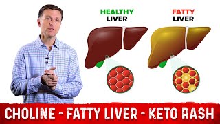 Choline One of The Best Vitamins for Fatty Liver – Dr Berg [upl. by Yasnil]