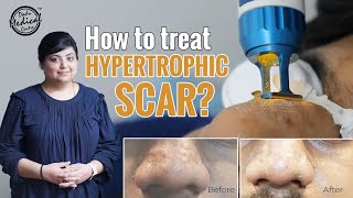 How To Treat Hypertrophic Scar  Hypertrophic Acne Scar  Bumps on Nose  Dr Nivedita Dadu [upl. by Eremihc]