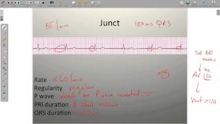 ECG Junctional Rhythms [upl. by Eerdua]