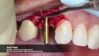 Onestage surgery using Tapered Internal PLUS dental implant from BioHorizons [upl. by Adihsar]