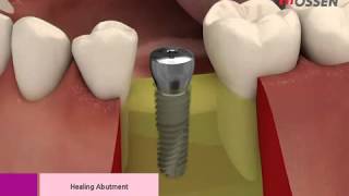 HiossenOsstem ETIII Implannt Placement with Taper Kit [upl. by Anitsyrk611]