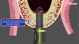 OSSTEM  HIOSSEN CASKit Crestal Approach Sinus Kit [upl. by Aihcila]