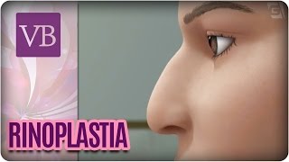 Rinoplastia  Você Bonita 120916 [upl. by Aduhey]