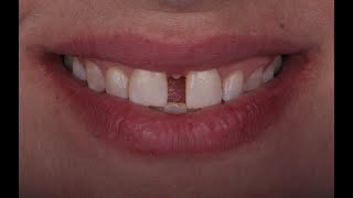 A combined approach for diastema closure [upl. by Mag353]