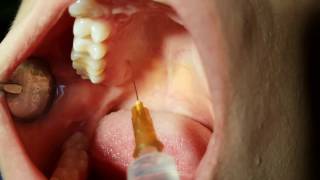 DENTAL ANESTHESIA TECHNIQUE  EXPLAINED [upl. by Piefer]