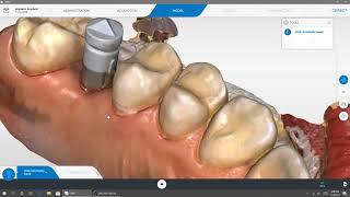 Digitally Restoring Hiossen Implants using CEREC at Garr Dental Center Carrington ND [upl. by Gulgee]